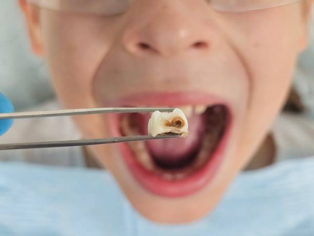 Best Emergency Treatment for Toothache in Panguitch, UT